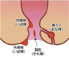 痔の3大疾患