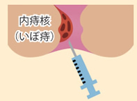 ジオン療法