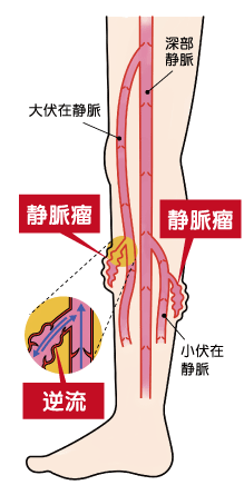 下肢静脈瘤