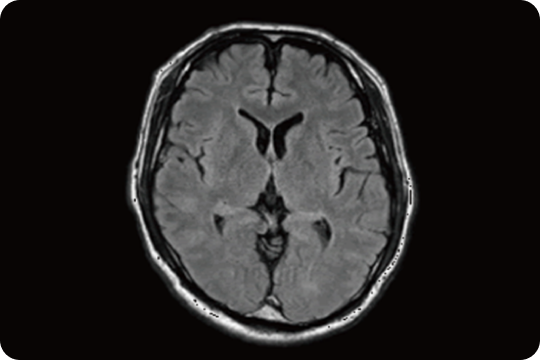 正常な脳のMRI