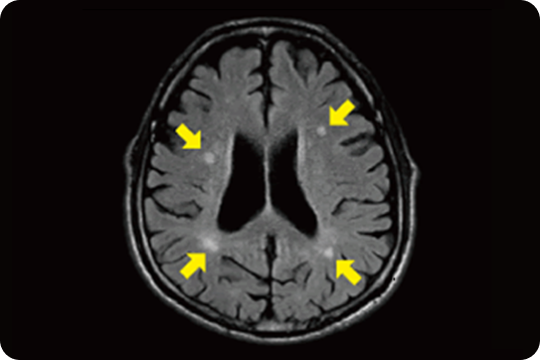 無性後性脳梗塞MRI