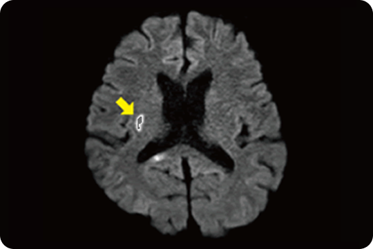 脳梗塞発症直後のMRI