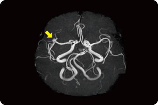 未破裂の動脈瘤MRA
